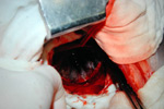 Damage to oesophagus
